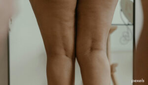 Types de cellulite